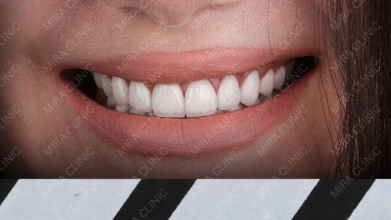 Hollywood smile look